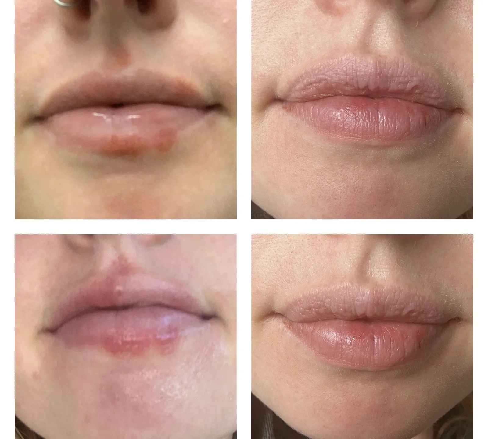 our skin-focused nutritionist's dermatitis transformation 