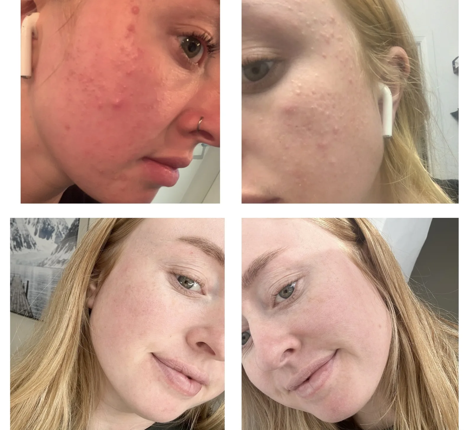 our skin-focused nutritionist's rosacea and acne transformation