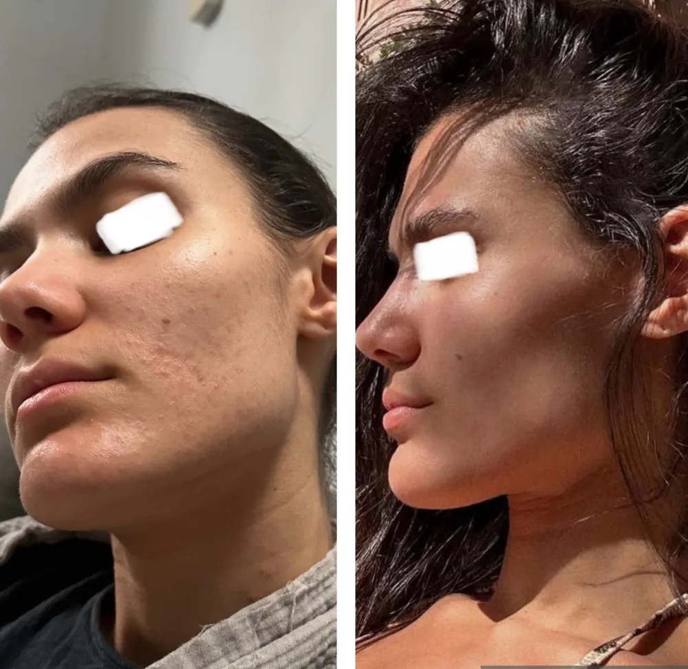 1:1 client acne transformation