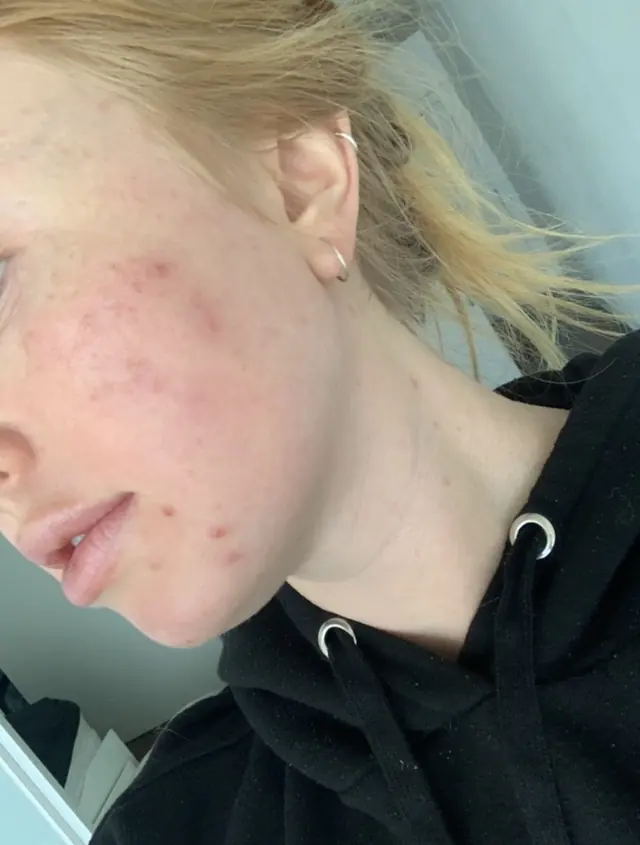 Side of a client's face with acne and redness
