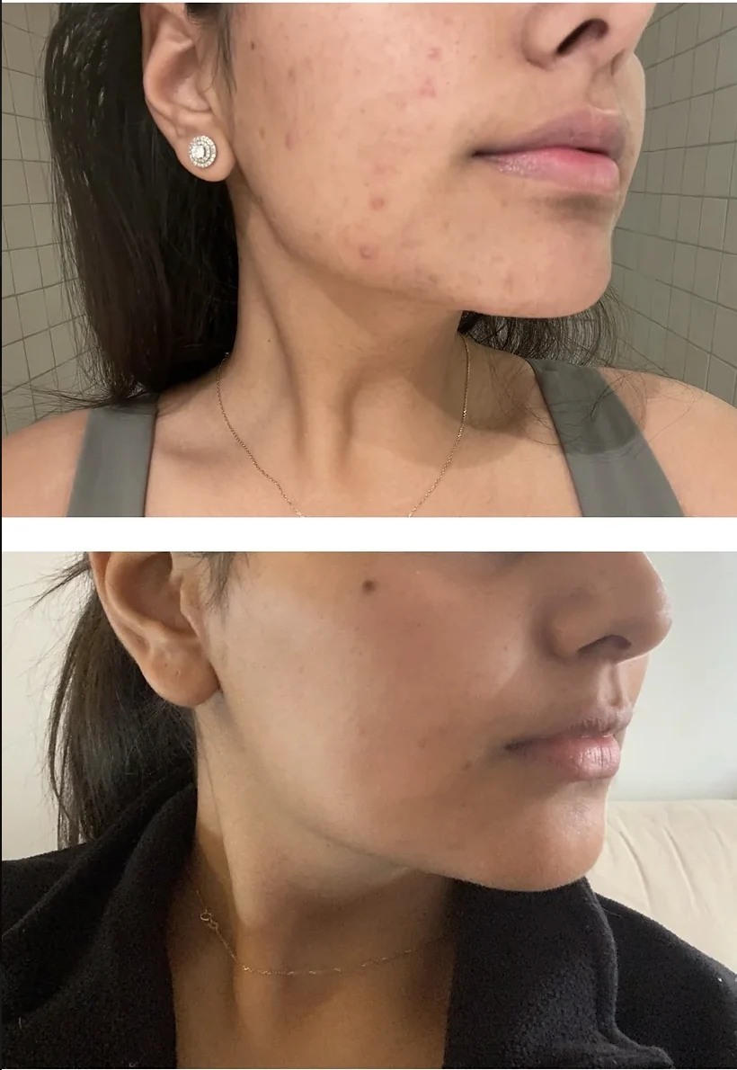 The Acne Solution student