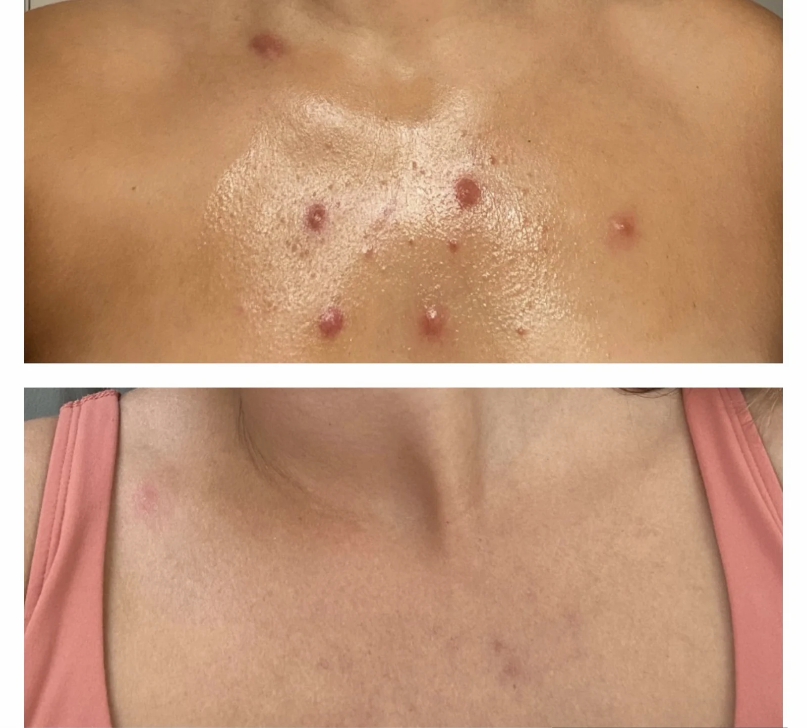The Acne Solution student
