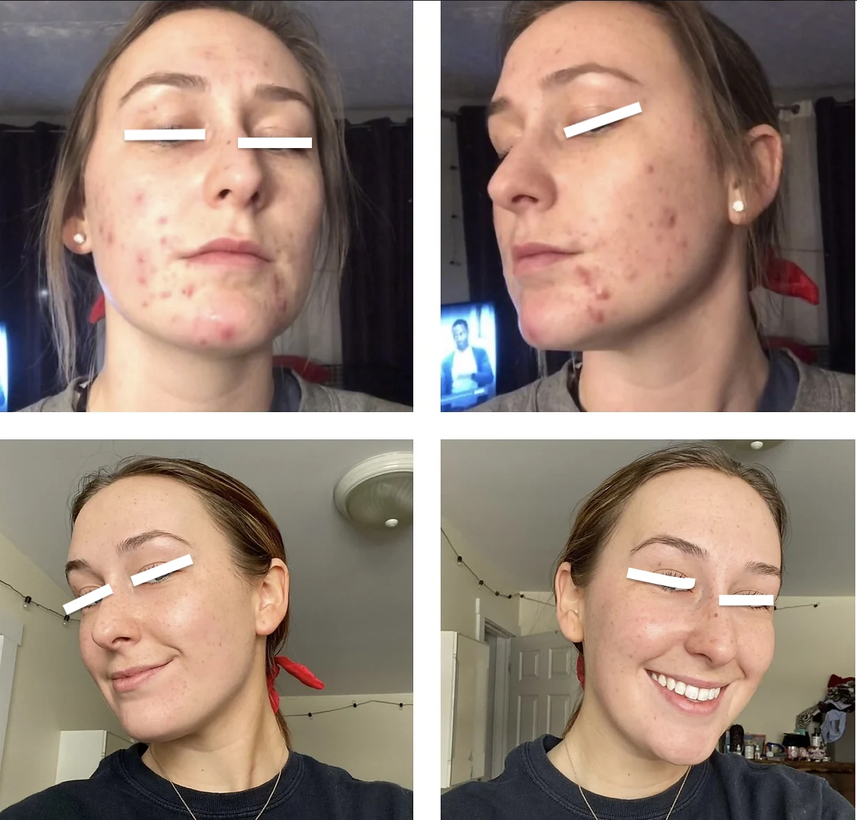 The Acne Solution student