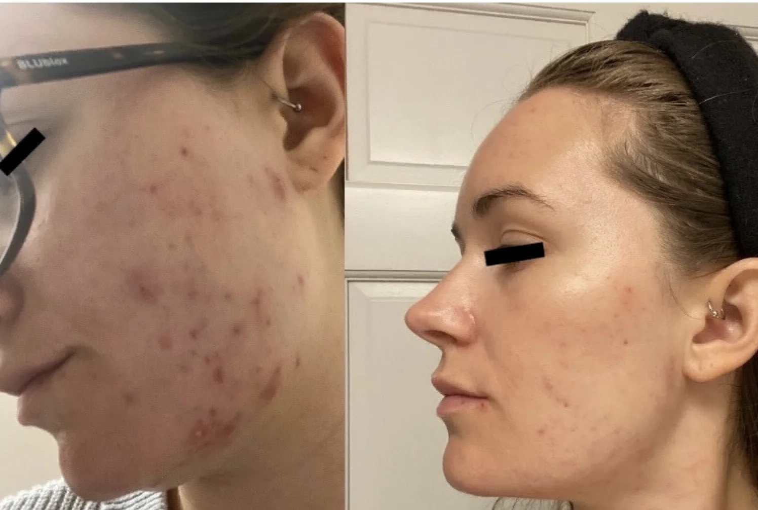 The Acne Solution student