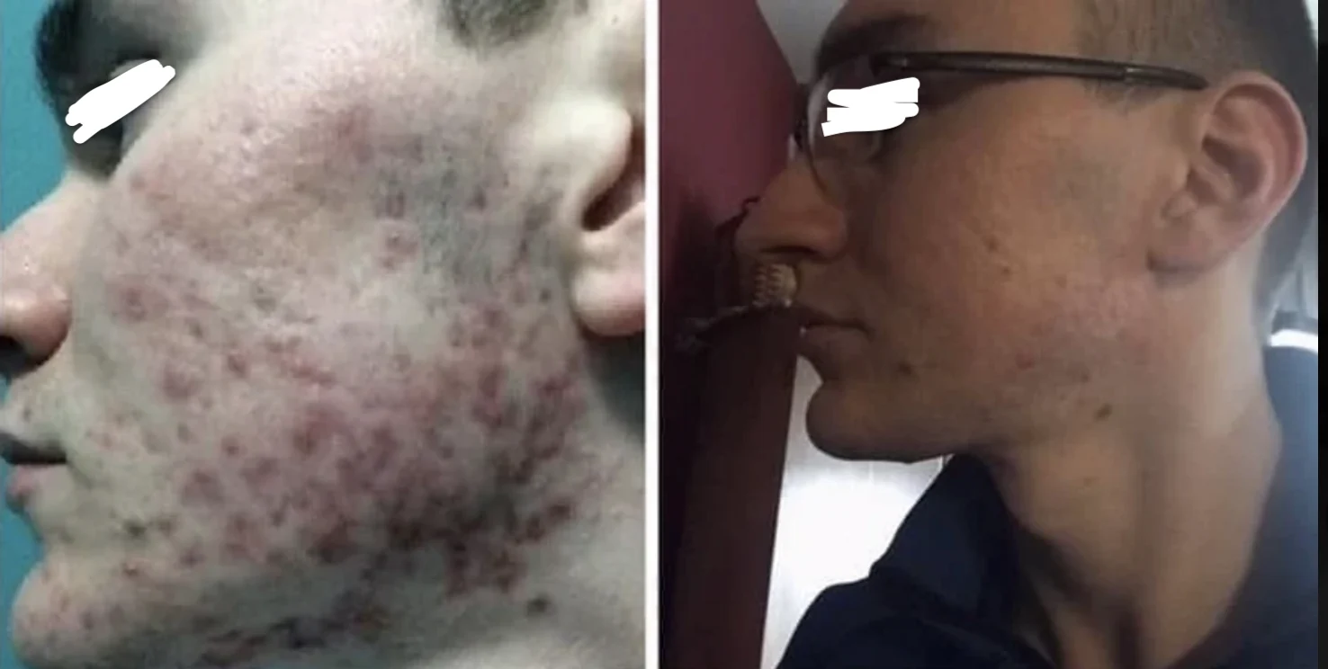 The Acne Solution student