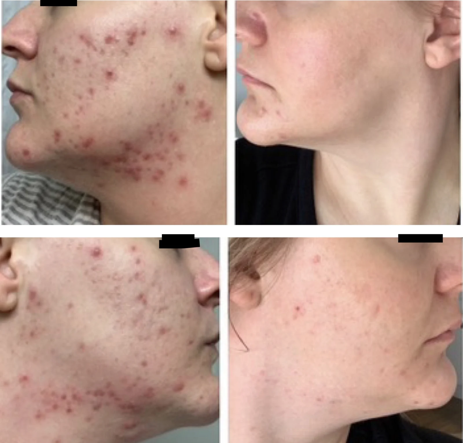 The Acne Solution student