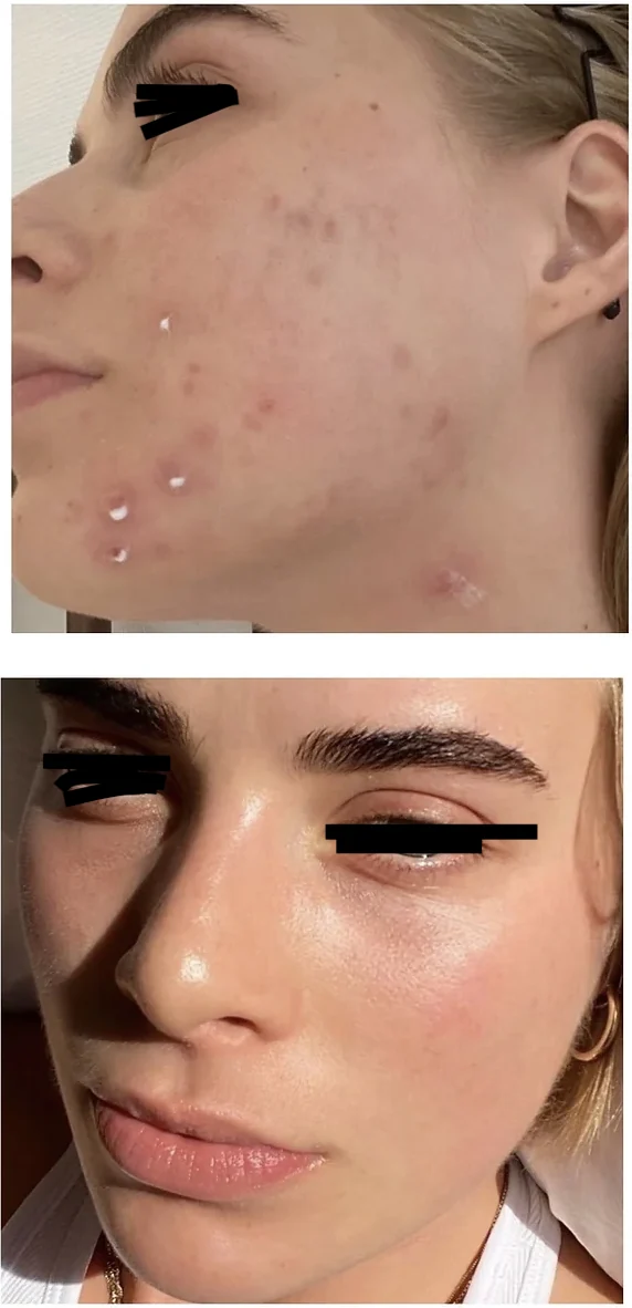 The Acne Solution student