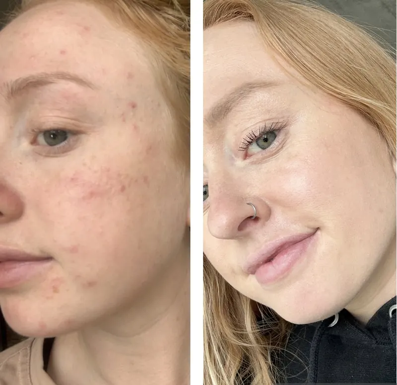 our skin-focused nutritionist's acne transformation