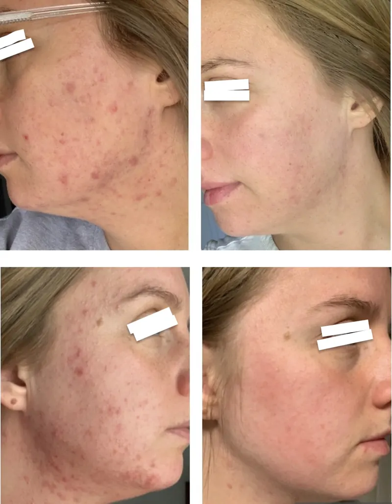1:1 client acne transformation
