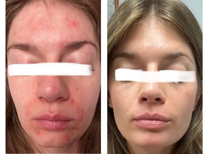 1:1 client acne transformation